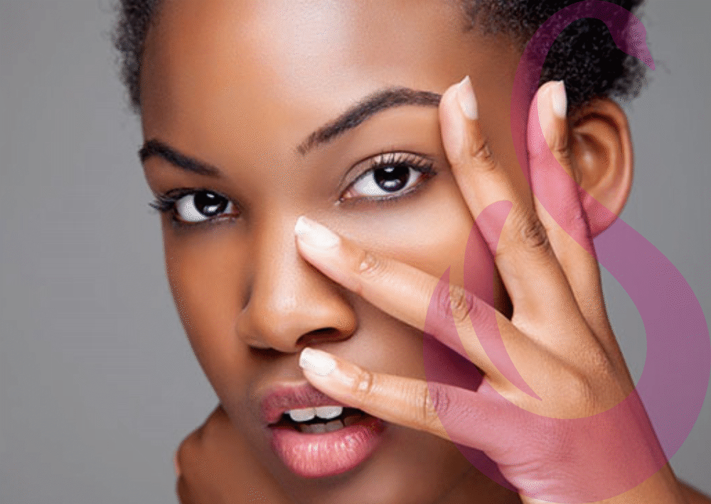 Dark Circles, Pigmentation Issues, Gravesend, Kent