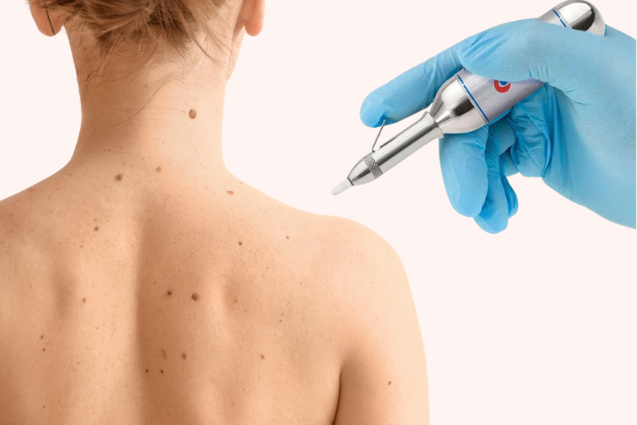 Mole & Skin Tag Removal