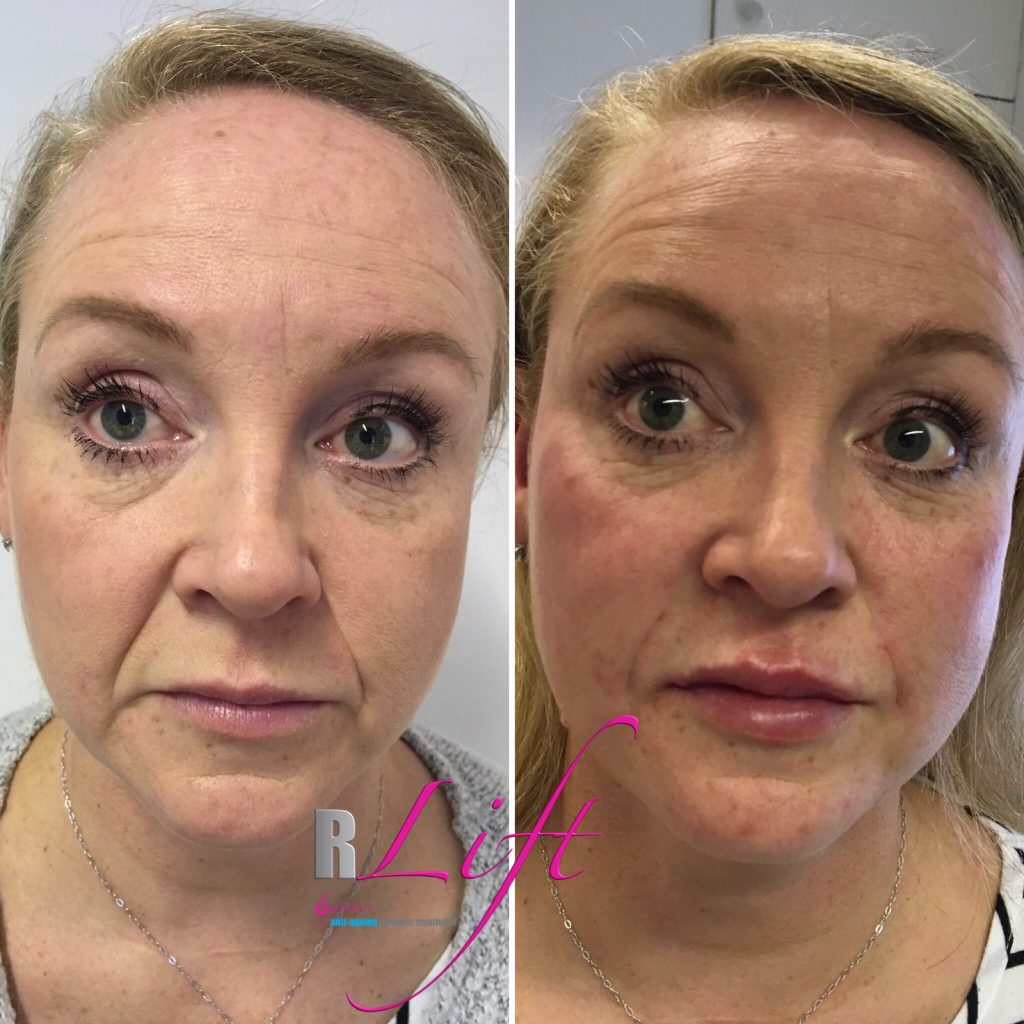 Cheek and Tear Trough Filler Treatments available in Gravesend, Kent