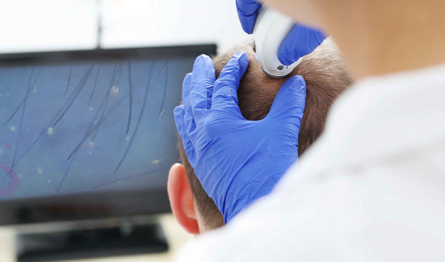 Hair Rejuvenation for Hair Loss Clinic Kent Gravesend 