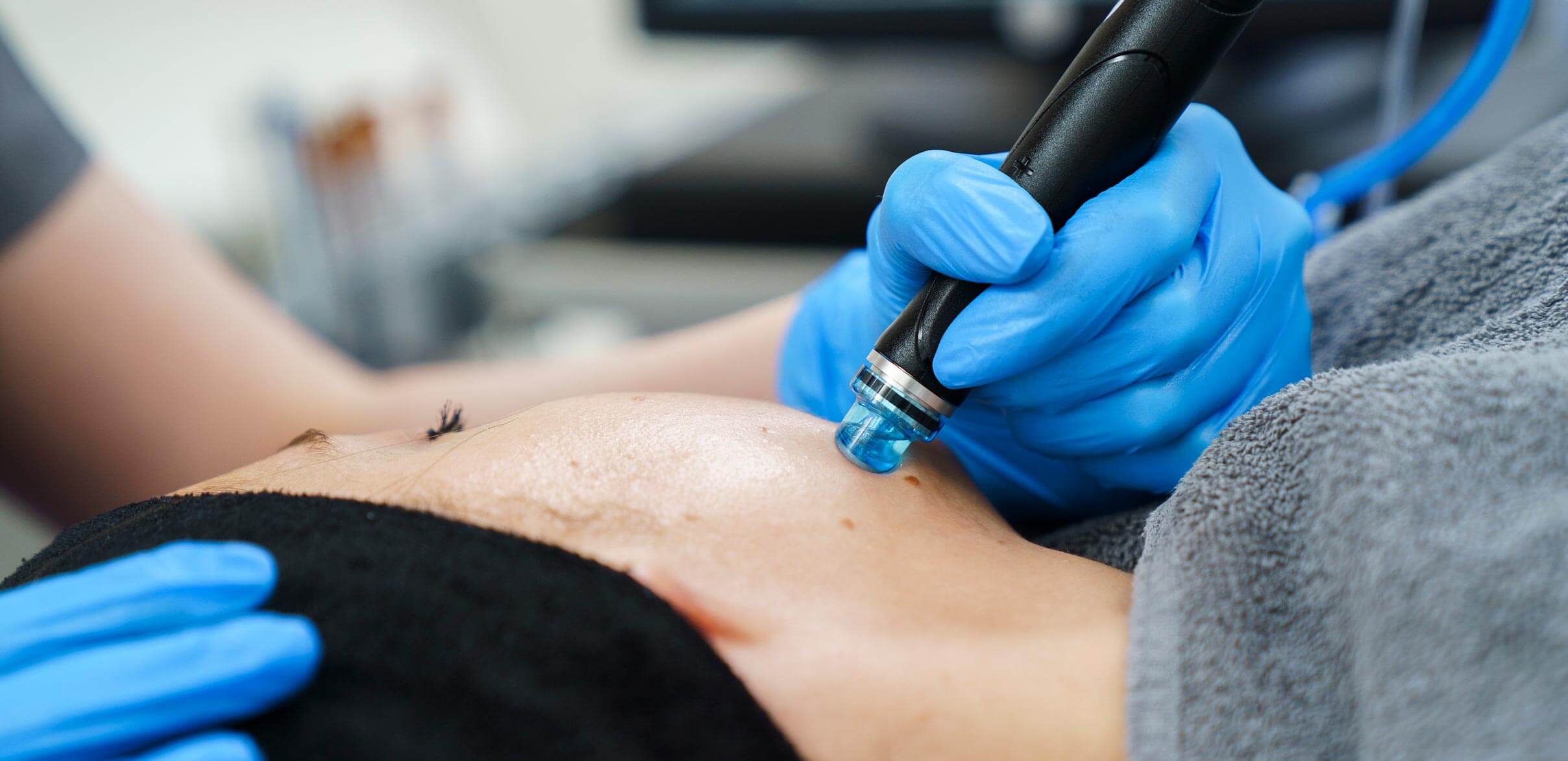HydraFacial treatment at Sculpture Clinic Gravesend Kent