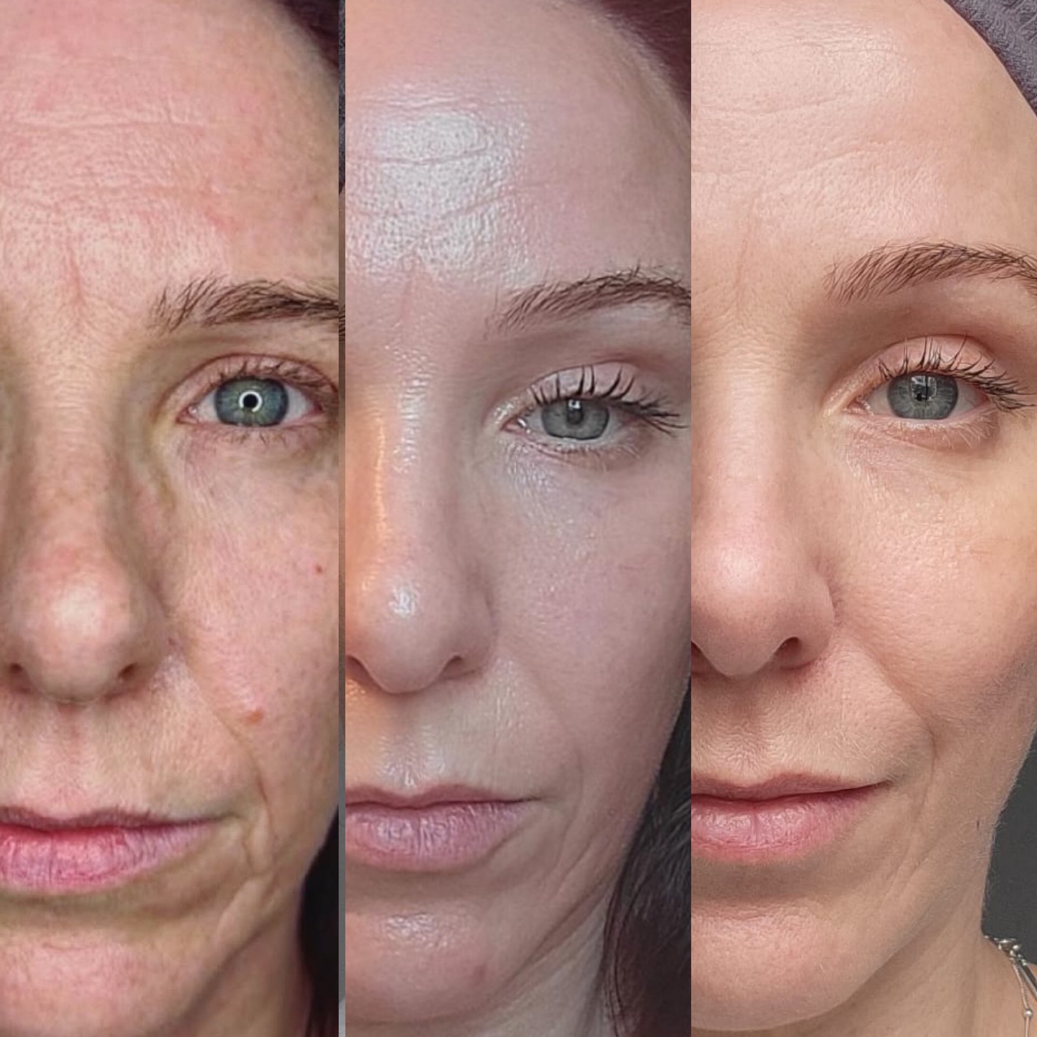 plasmatology-Group-Neogen-1-month-and-3-month-medium-energy-1.8-on-face-1.5-on-eyes-and-a-few-sun-spots-hit-with-a-pulse-of-high-energy-follow-up-MODEL-BAILEY-42YRS-OLD