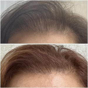 Hair loss treatments