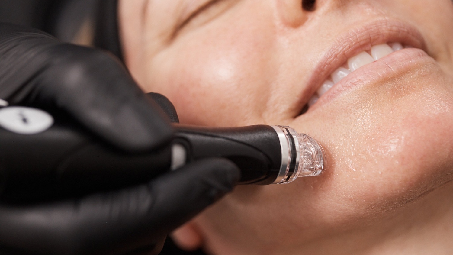 Personalised Hydrafacial treatment using the Vortex-Fusion handpiece at Sculpture Clinic in Gravesend.